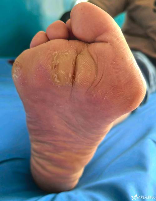 脚得风湿的症状有哪些