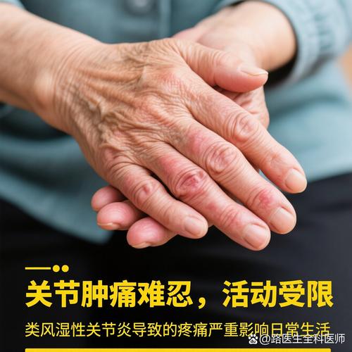 游走性类风湿能治好吗