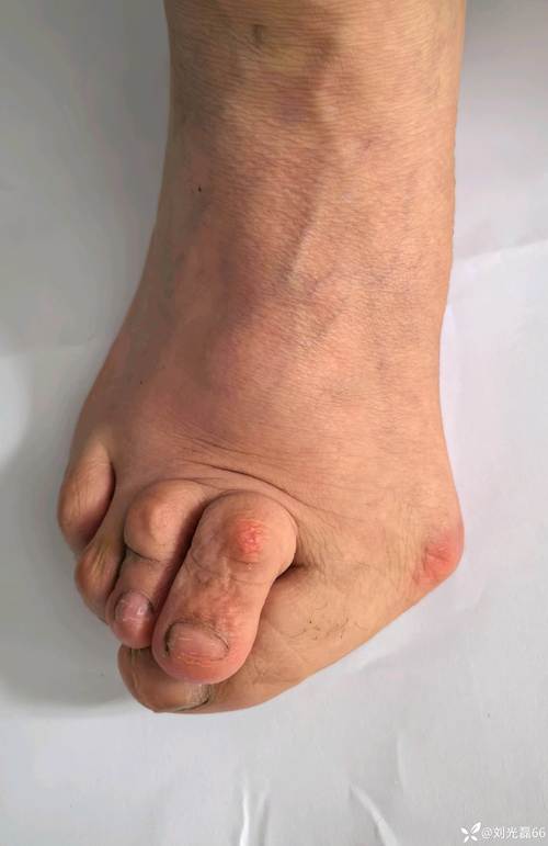 因为类风湿脚会变黑么