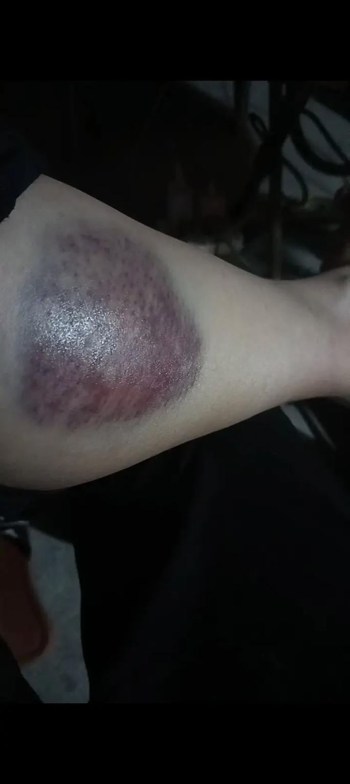 按摩穴位后出现乌青