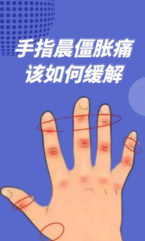 手指关节风湿能自愈吗