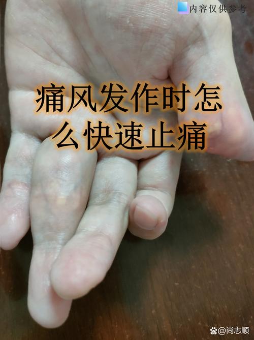 风湿结缔组织会发烧吗