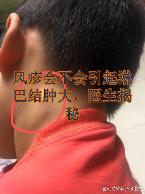 风湿结缔组织会发烧吗