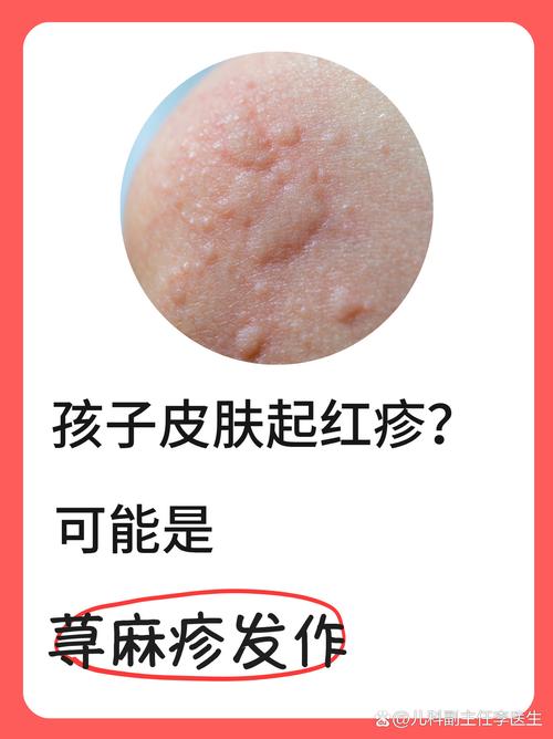 孩子出风湿疙瘩怎么办