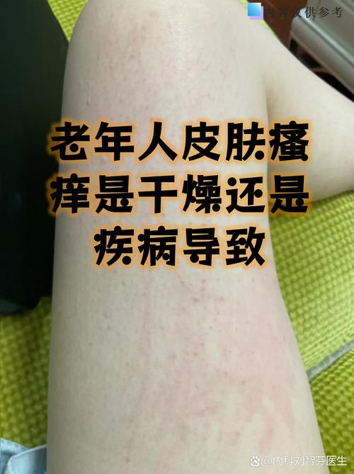 北方干燥不容易得风湿