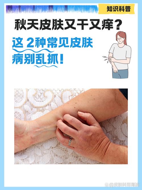 北方干燥不容易得风湿