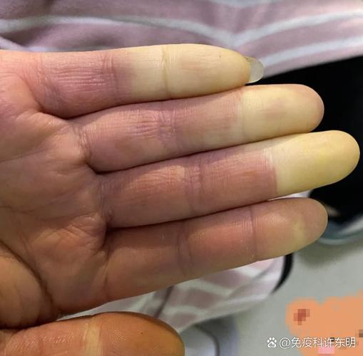 北方干燥不容易得风湿