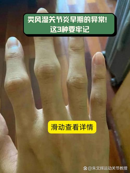 手指关节疼痛是风湿吗