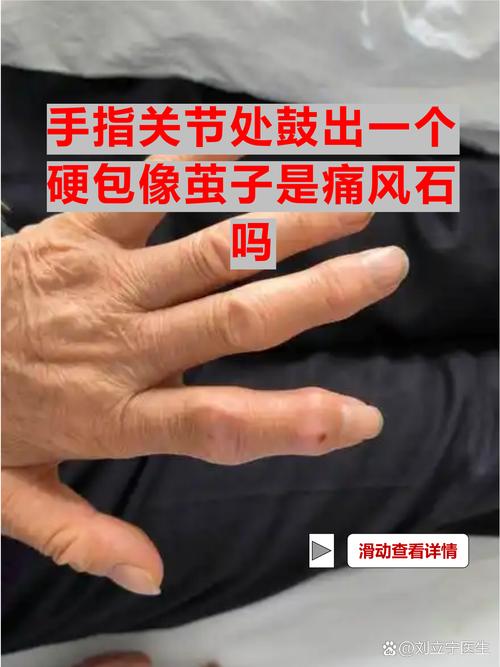 手指关节疼痛是风湿吗