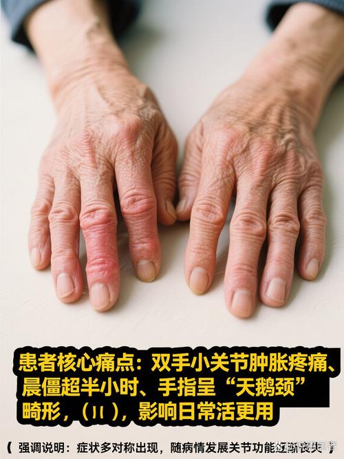 类风湿症状需要住院吗