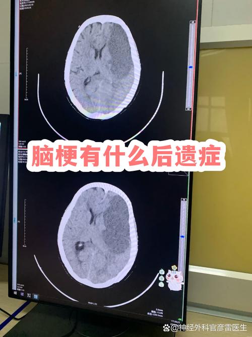 脑梗病人会恢复记忆吗