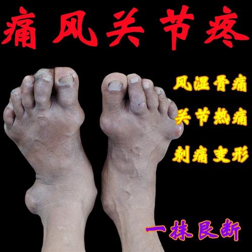 脚面风湿关节炎什么药