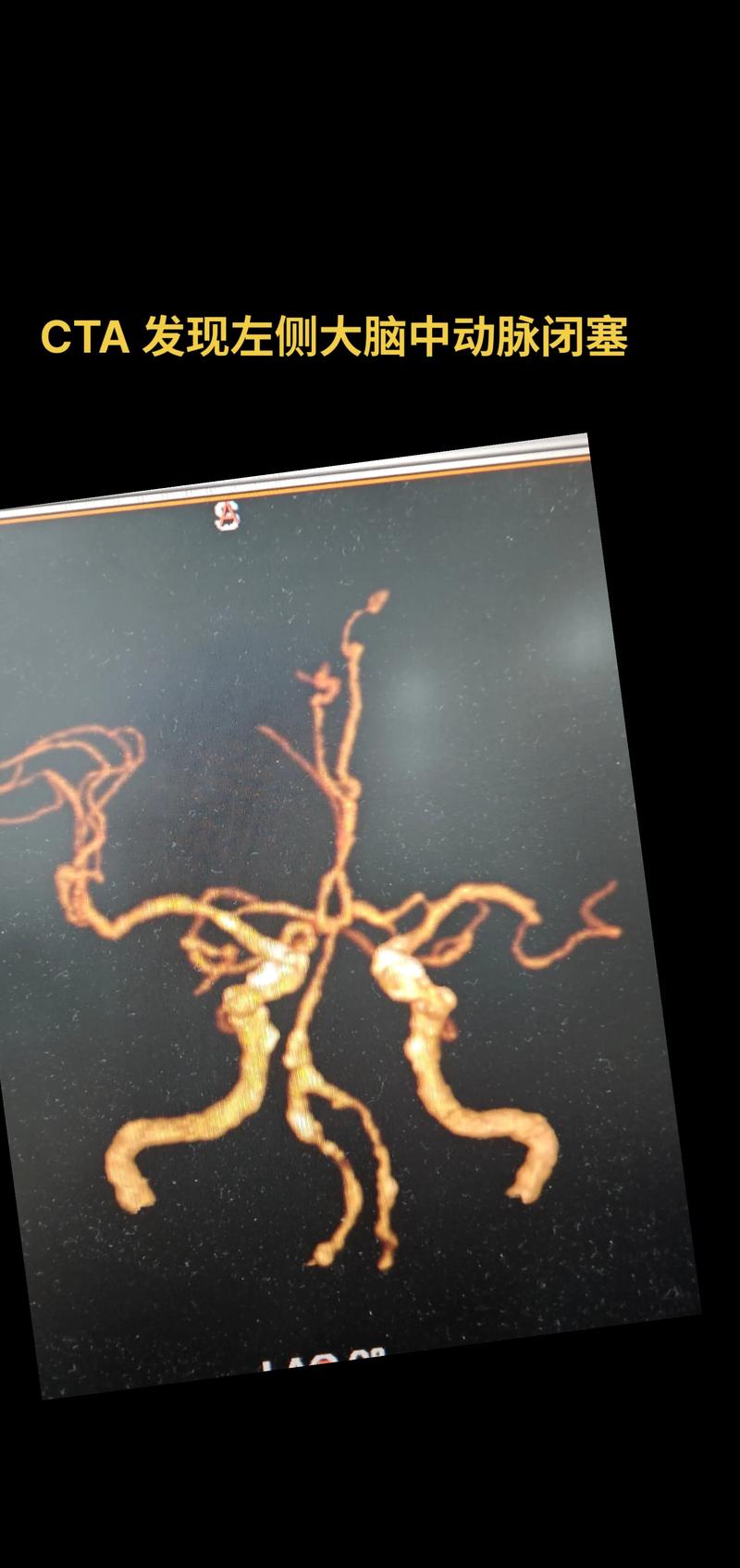 脑梗血管造影能治病吗