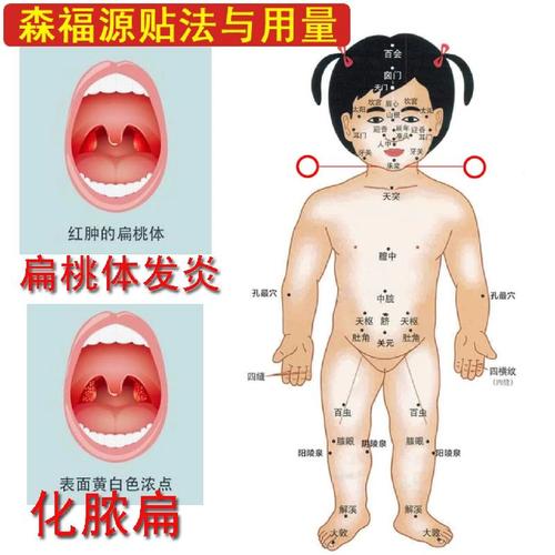 宝宝喉炎灸什么穴位