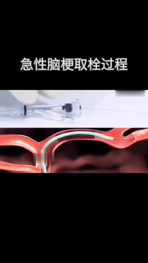 脑梗搭桥手术怎么回事