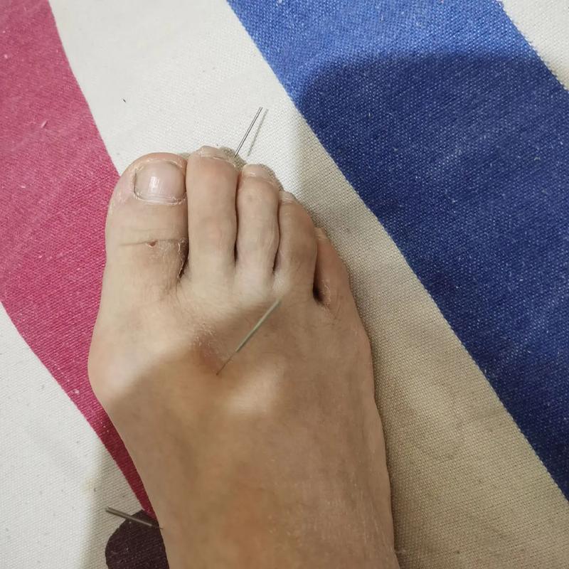 厉兑穴位功效图视频