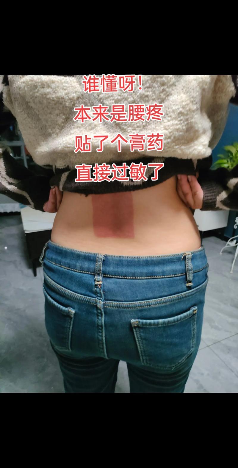 贴了风湿膏感觉火辣辣