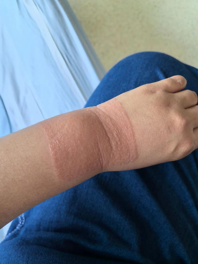 贴了风湿膏感觉火辣辣