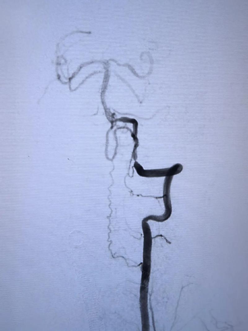 脑梗血管支架手术风险