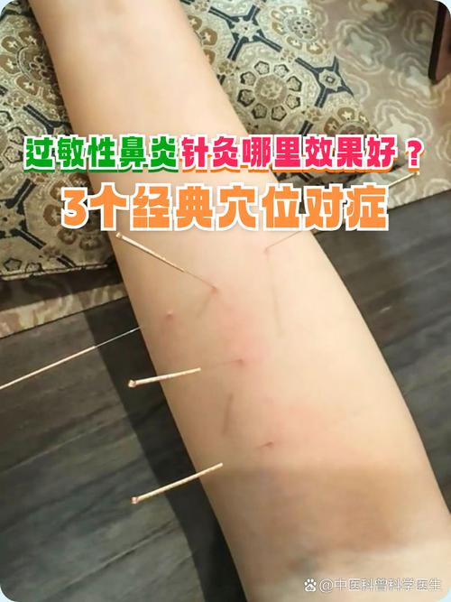 哪个穴位可以抗过敏