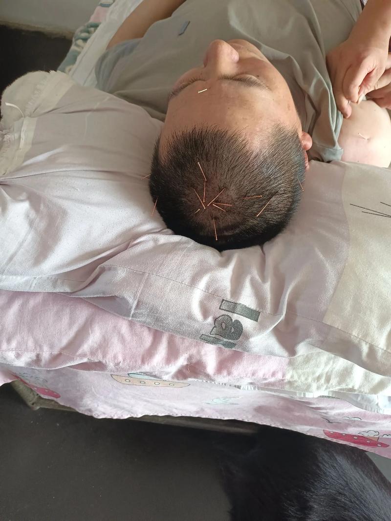 脑梗患者多久可以针灸