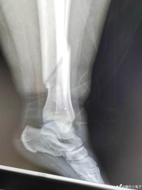腿部风湿需要拍片子吗