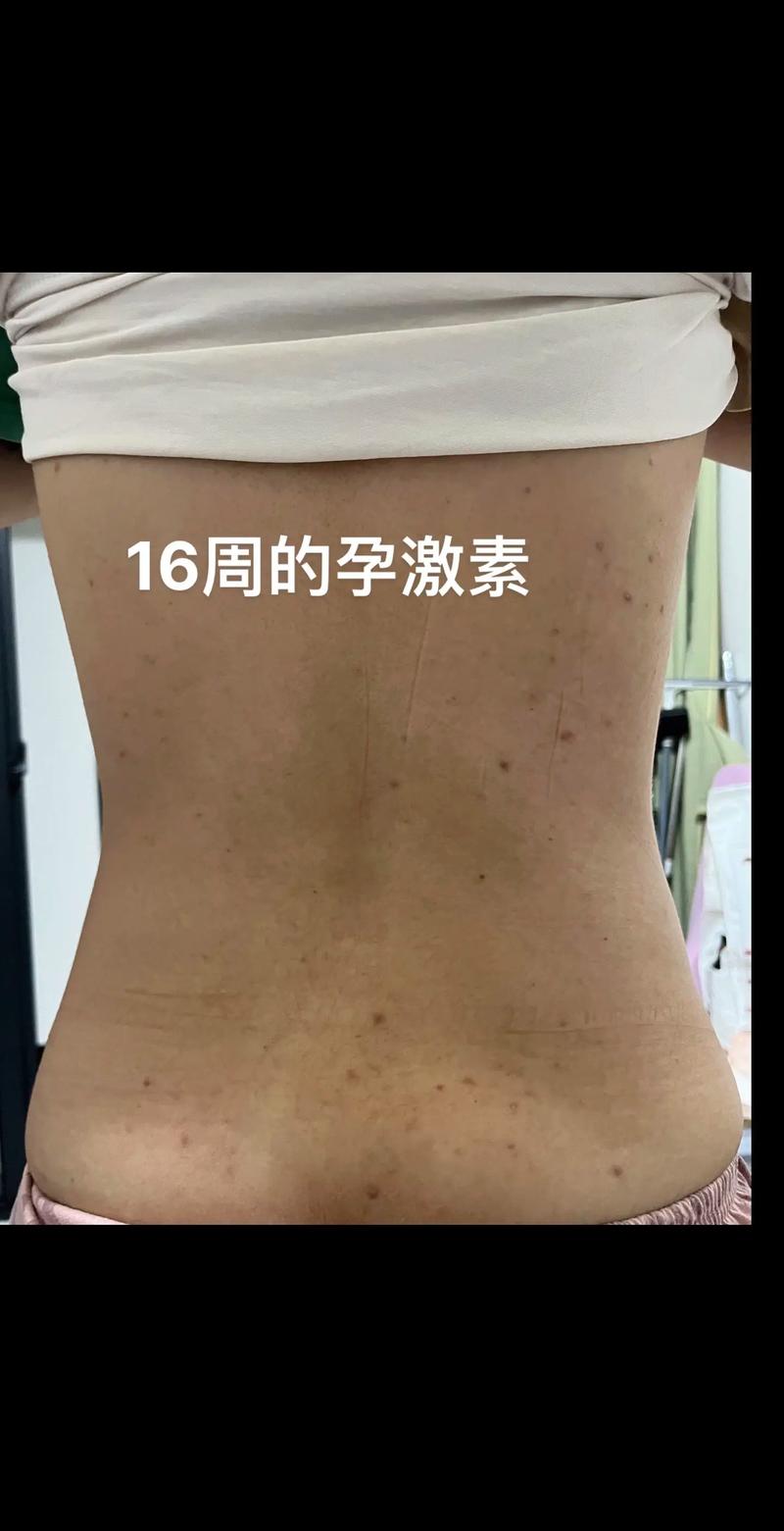 孕期长风湿疙瘩怎么办