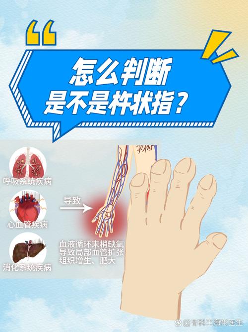 手指类风湿变形怎么办