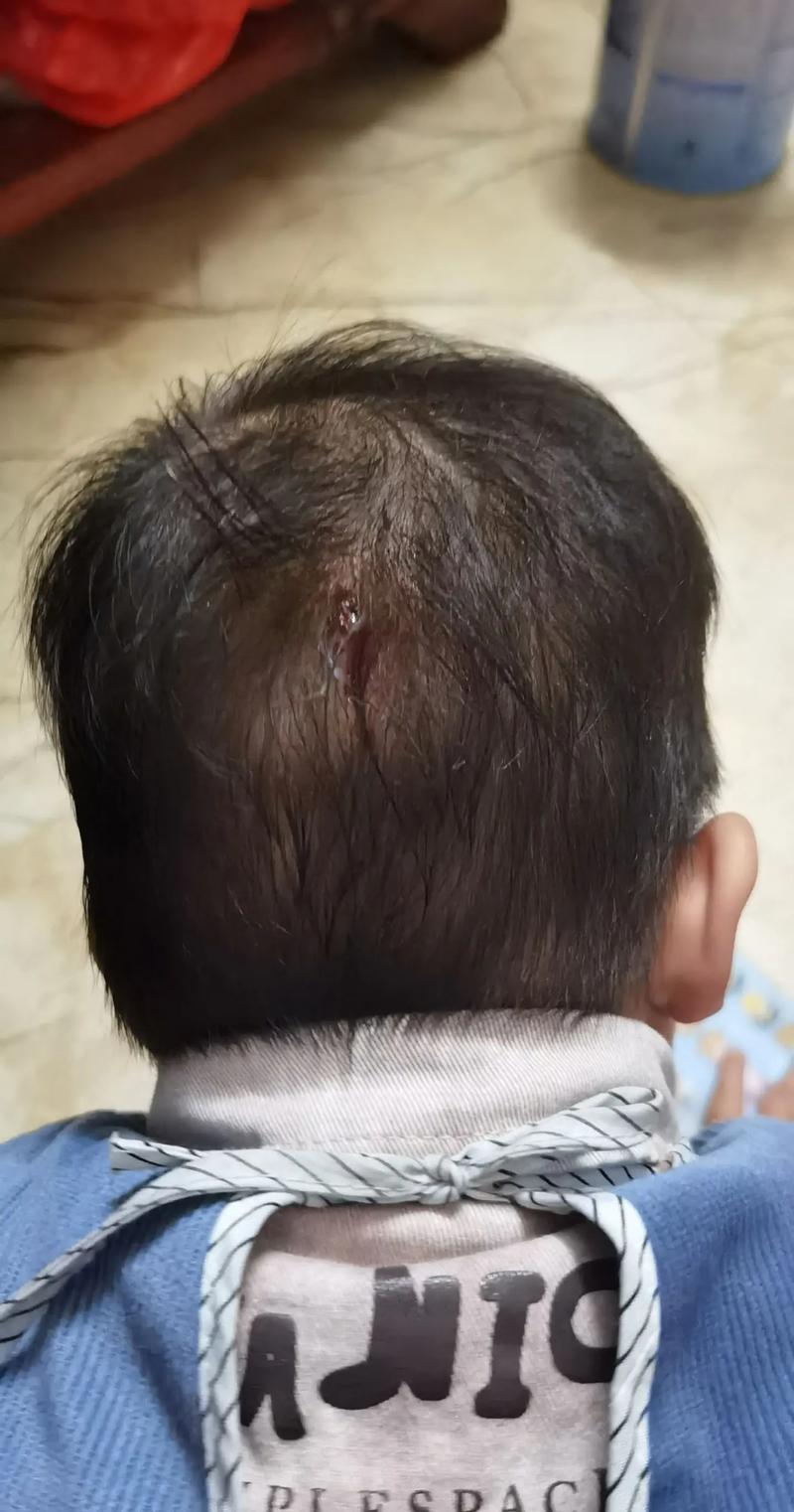 脑梗患者摔倒撞到脑袋