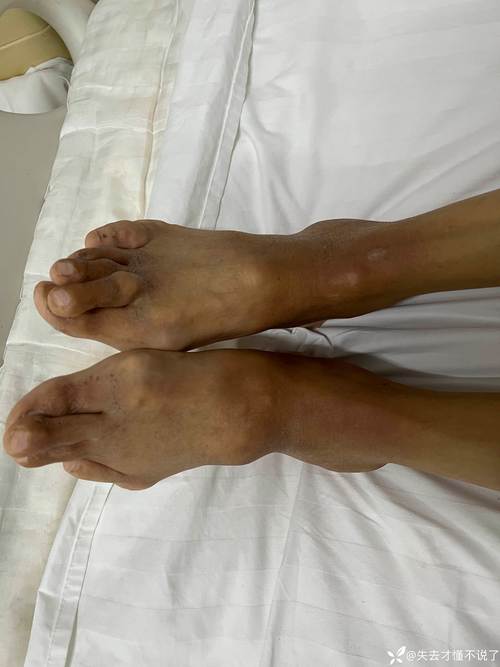 公务员体检 有类风湿