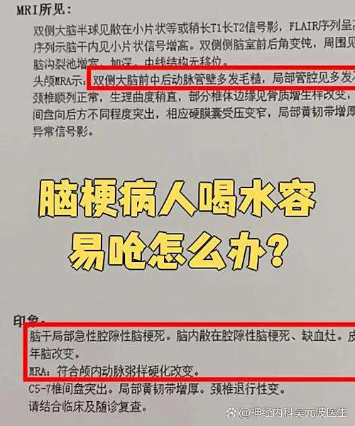 脑梗喝水呛 如何恢复