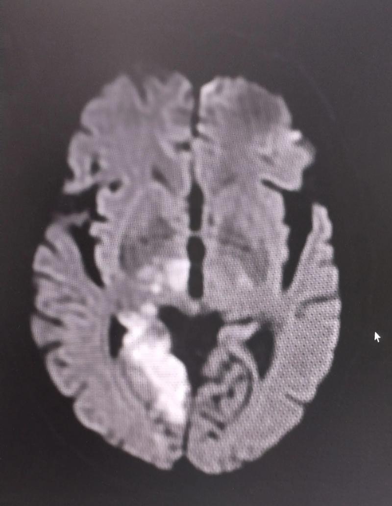 双侧放射冠腔梗是脑梗