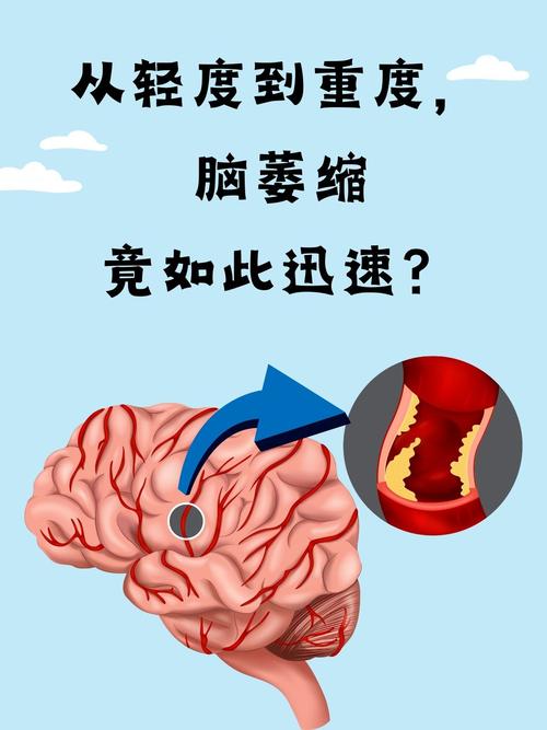 脑梗和小脑萎缩一样吗
