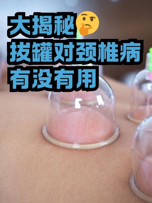 风湿关节拔火罐有用吗