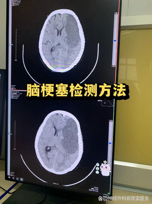 脑梗做核磁需要多少钱