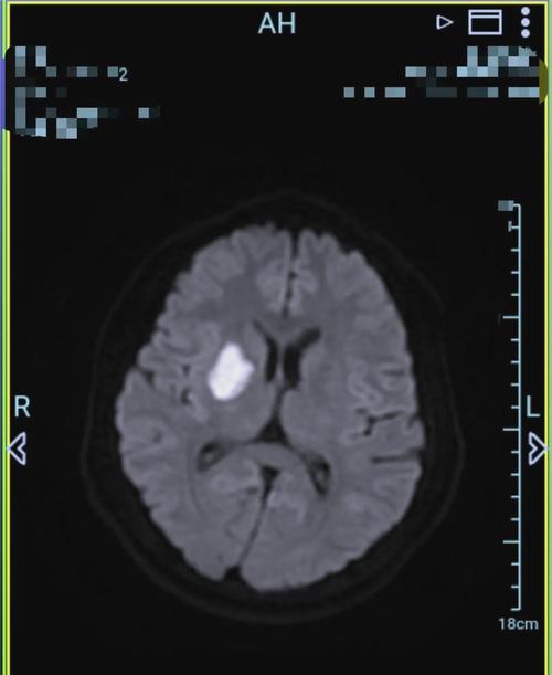 卢脑右侧基底节区腔梗