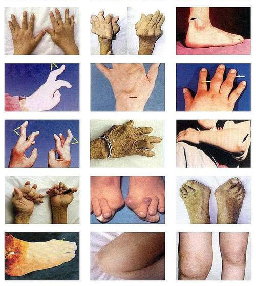 类风湿活动的判断指标