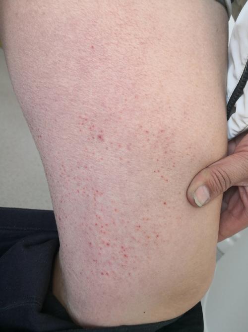 过敏免疫风湿病的症状