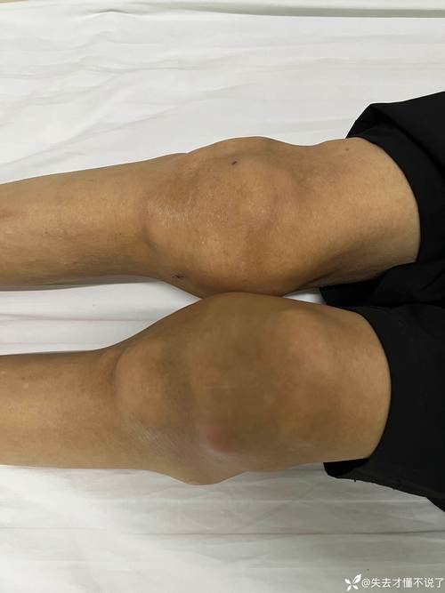 风湿关节炎走路后加重