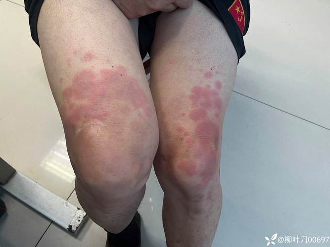 风湿病红斑有什么症状