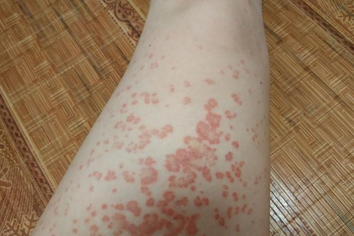 风湿病红斑有什么症状