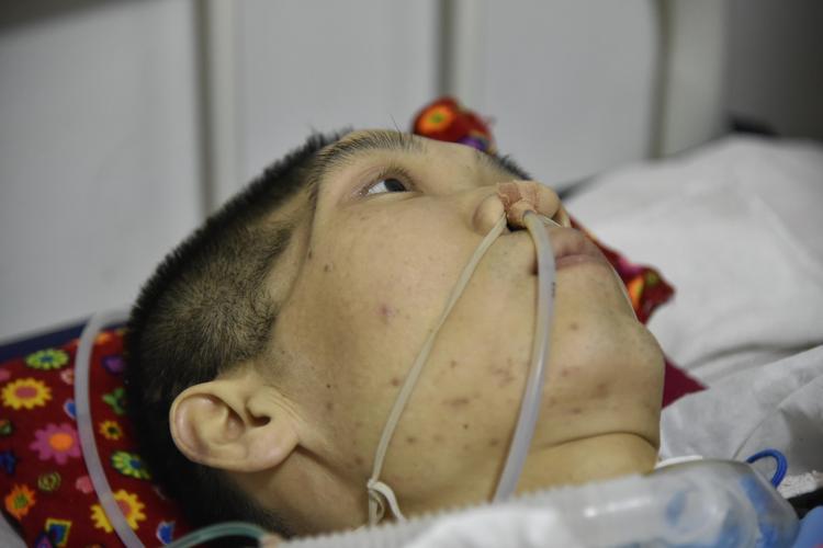 脑梗病人鼻饲管并发症