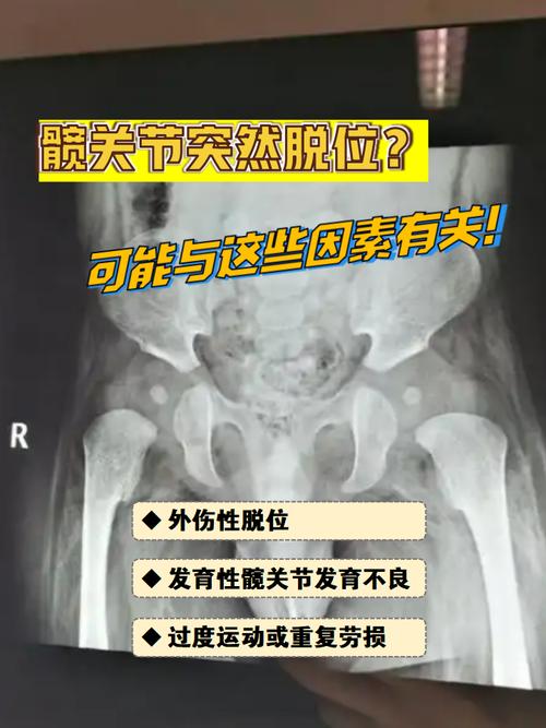 髋骨关节病是不是风湿