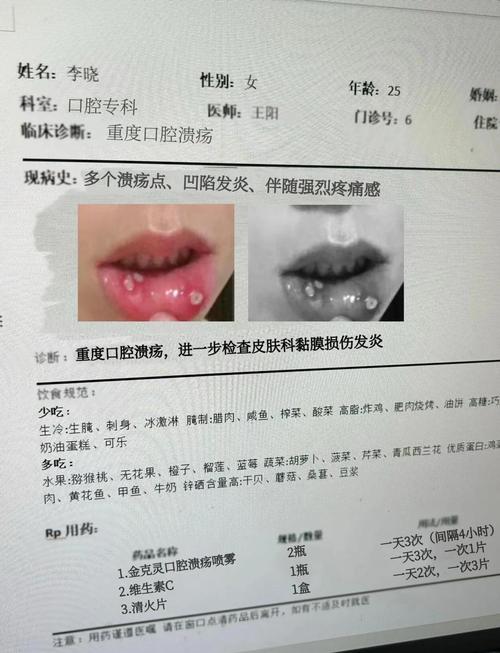 口腔溃疡看风湿免疫科