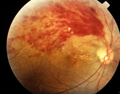 脑梗眼底出血什么样的