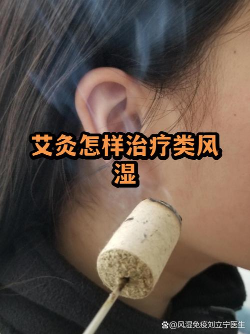 艾灸治疗内风湿关节炎