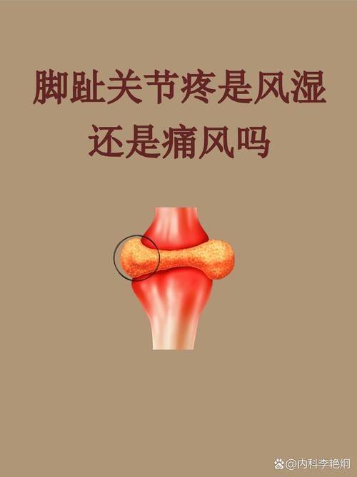 产后痛风和风湿的区别