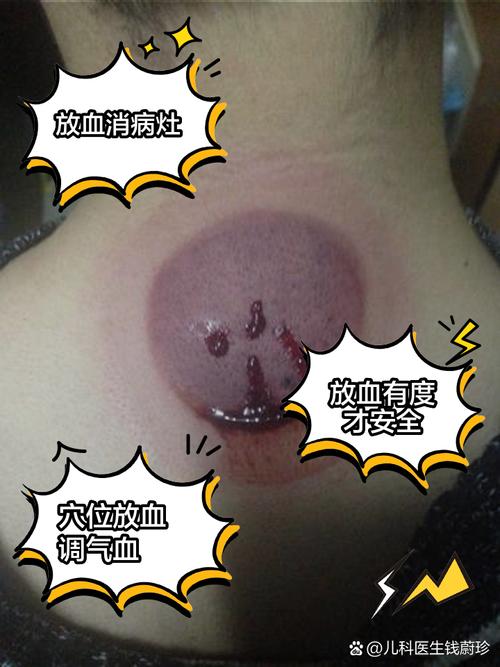 放血疗法能治类风湿吗