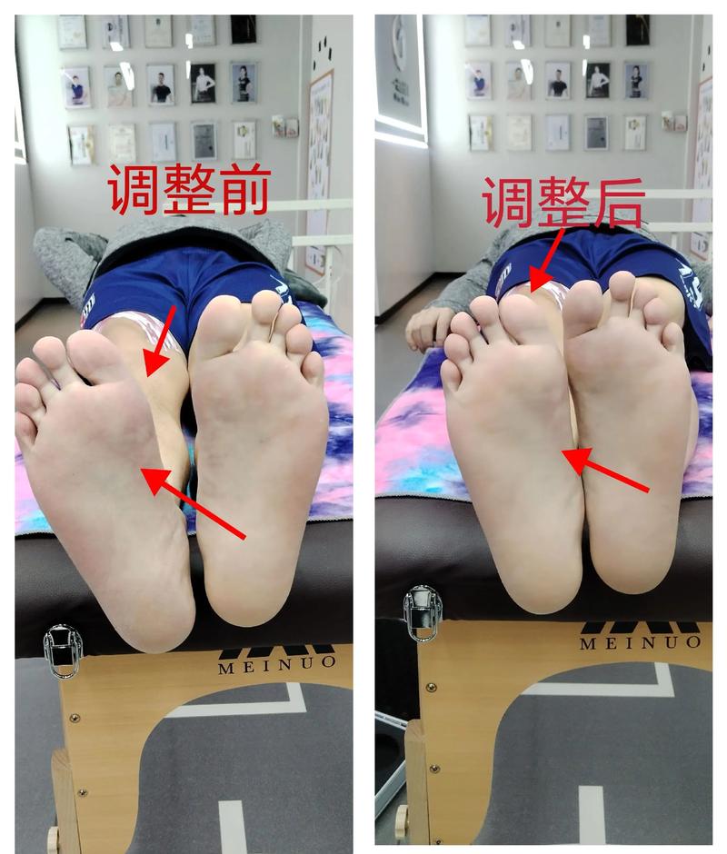 脑梗后足内反怎么锻炼