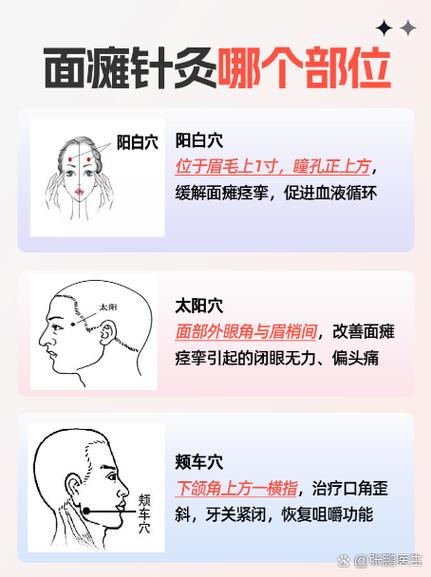 按哪个穴位治疗面瘫